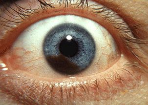 iris melanoma